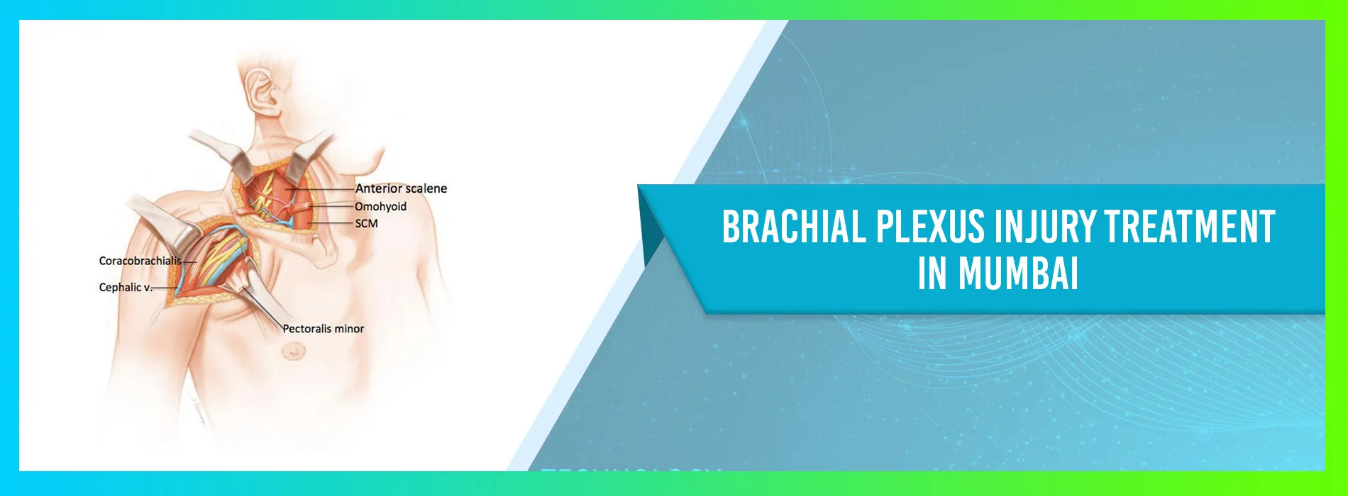 Brachial Plexus Injury Treatment in Mumbai