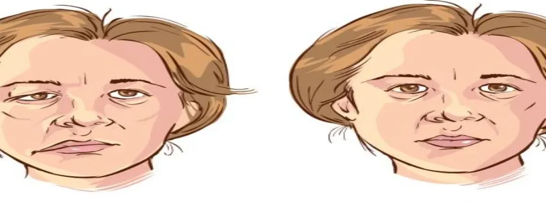 Facial palsy Surgery