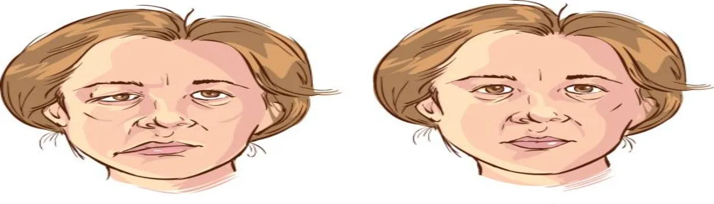 Facial palsy Surgery