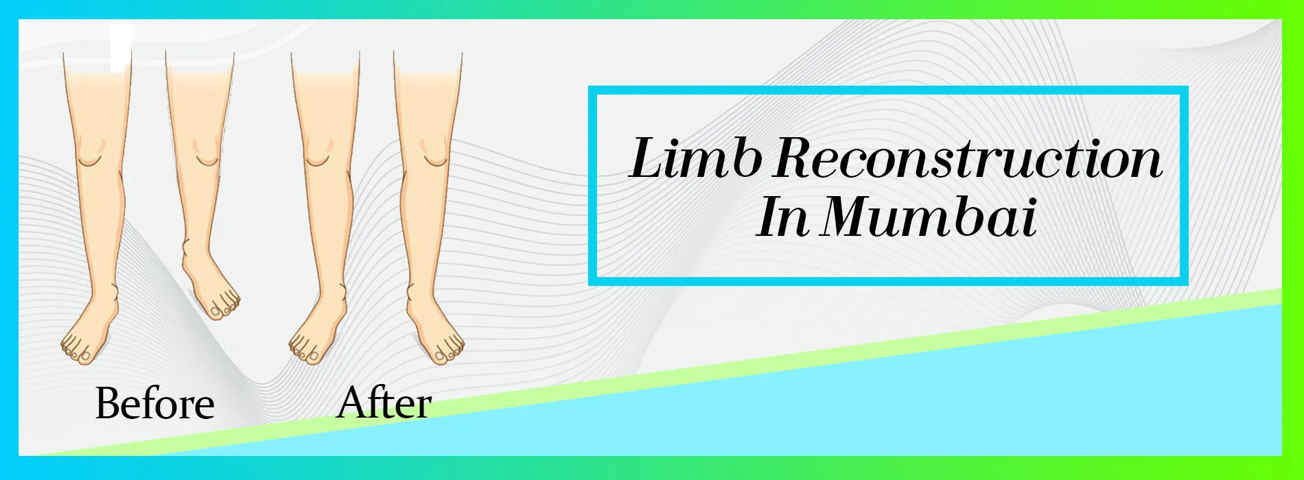 Limb Reconstruction Surgery Doctor in Mumbai