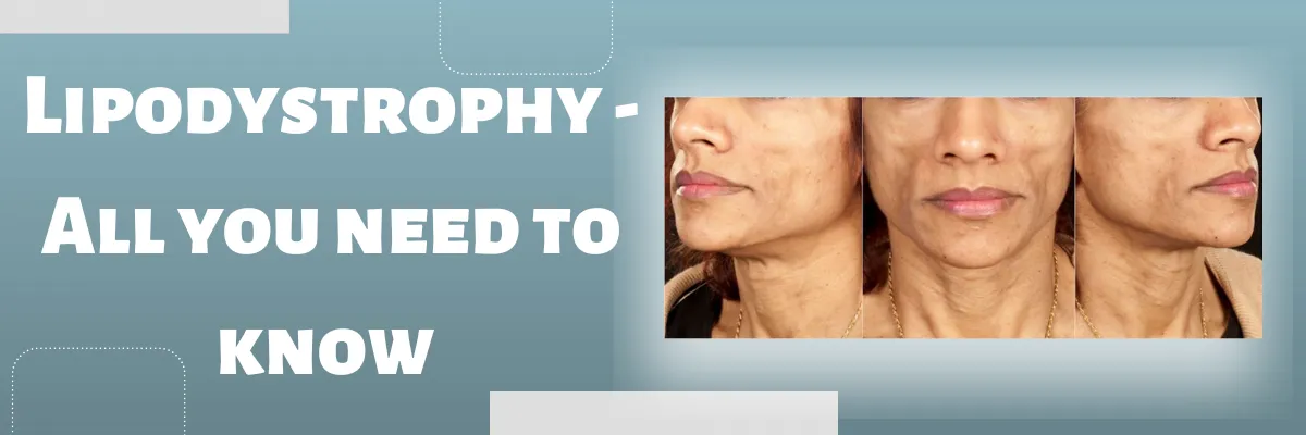 Lipodystrophy – All you need to know