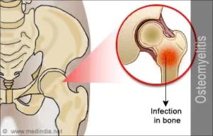 Long-standing osteomyelitis