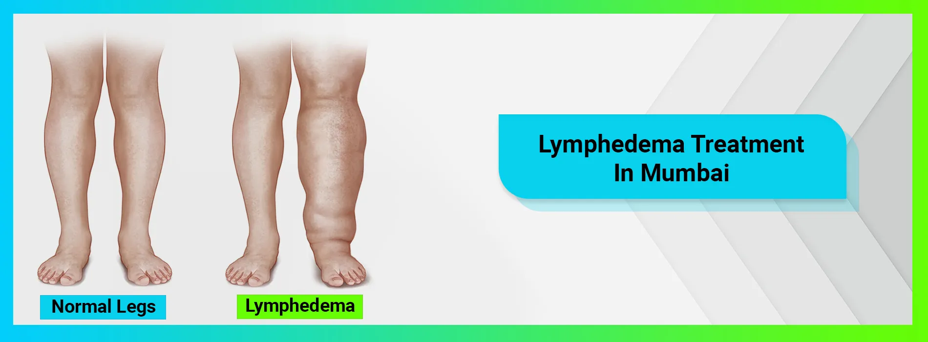 Lymphedema Treatment Doctor in Mumbai