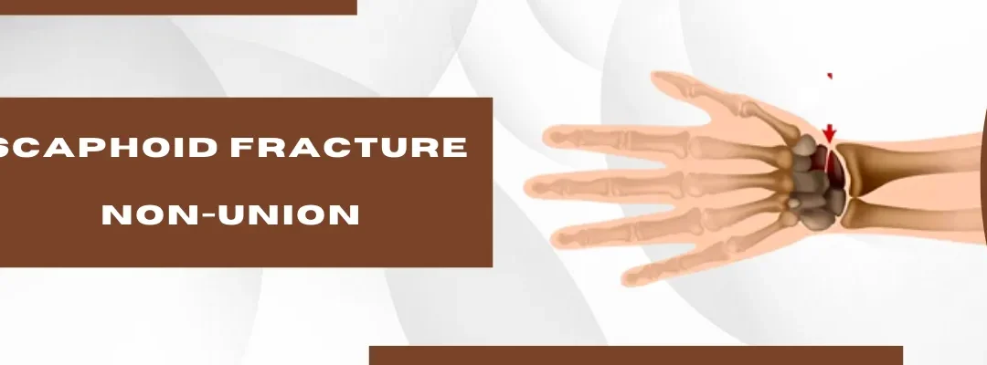 Scaphoid Fracture Non-Union