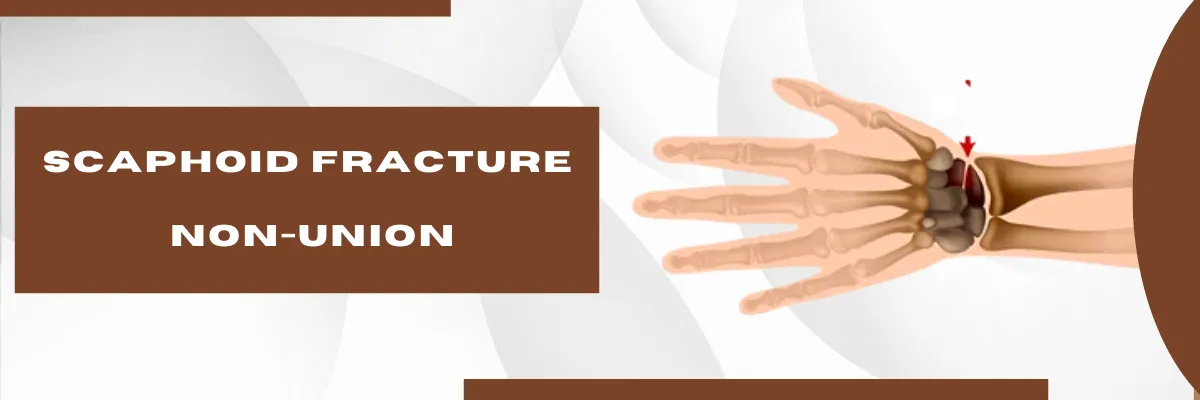 Scaphoid Fracture Non-Union