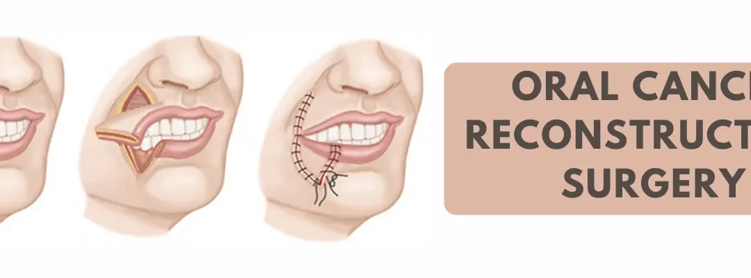 Things You Should Know About Oral Cancer Reconstruction Surgery