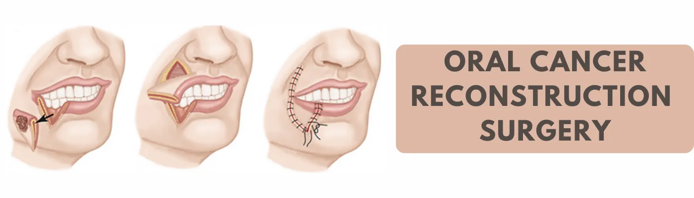 Things You Should Know About Oral Cancer Reconstruction Surgery
