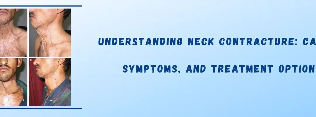 Understanding Neck Contracture: Causes, Symptoms, and Treatment Options