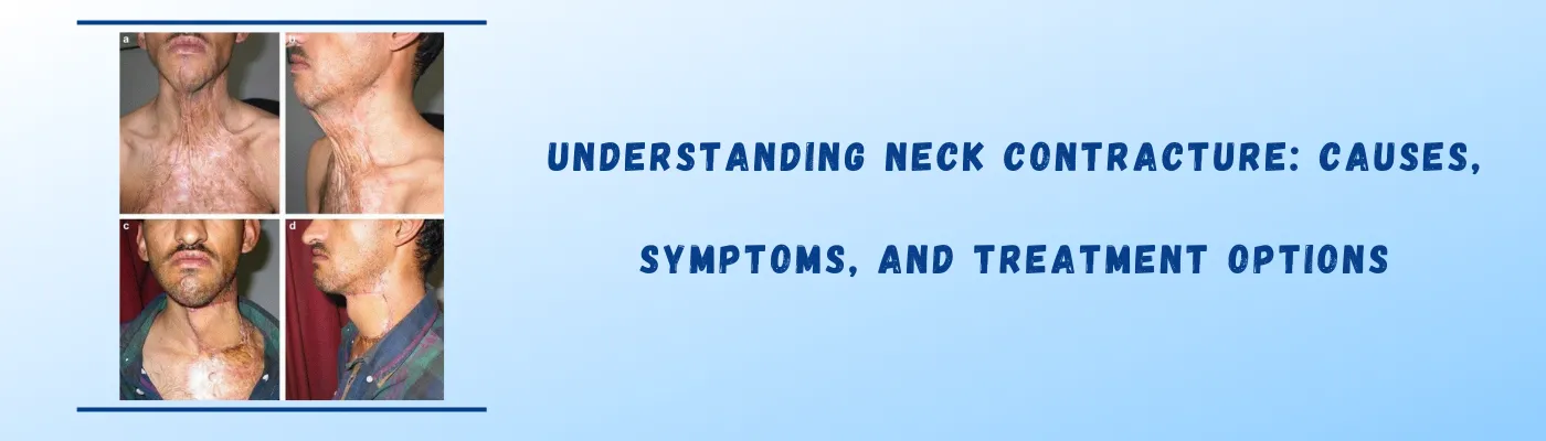 Understanding Neck Contracture: Causes, Symptoms, and Treatment Options