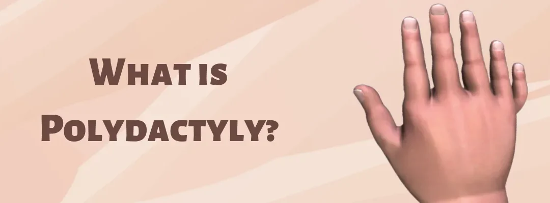 What is Polydactyly?