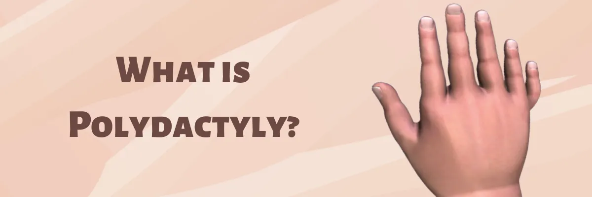 What is Polydactyly?