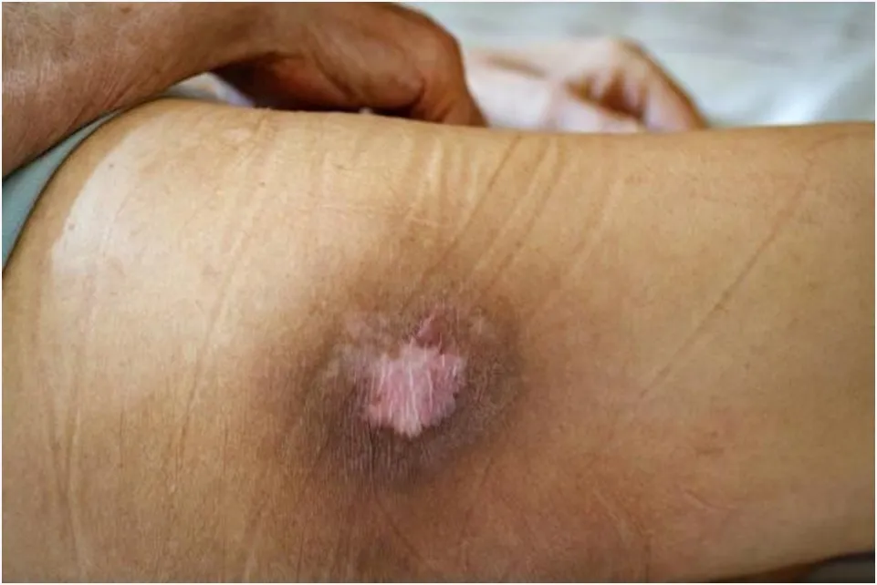 Bed Sores