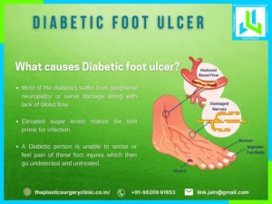 causes diabetic foot ulcers
