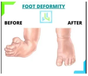 foot-deformity
