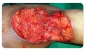 Hidradenitis Suppurativa Before