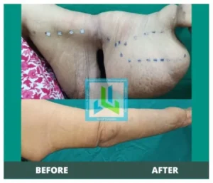 lymphedema of upper limb