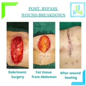 post-bypass-wound-breakdown - Dr Leena Jain post-bypass-wound-breakdown