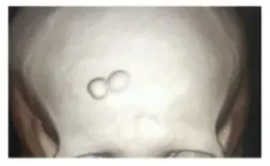 xray-before