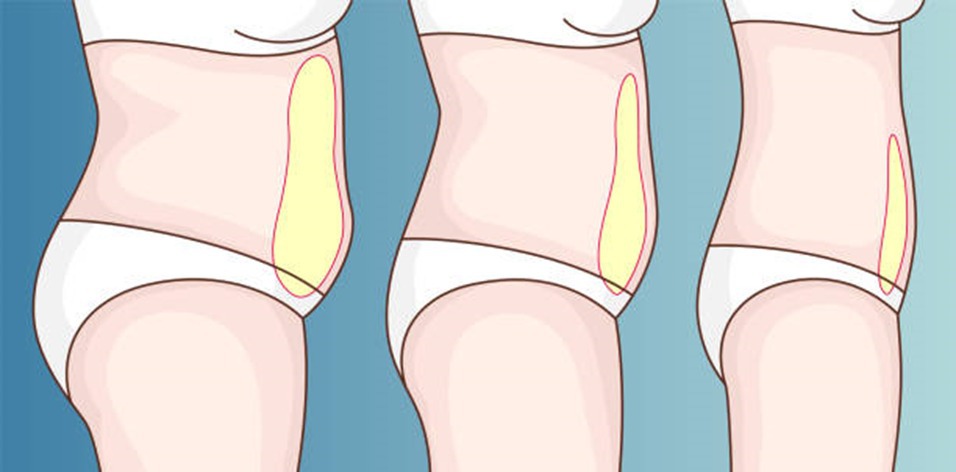 6 Weeks After Tummy Tuck