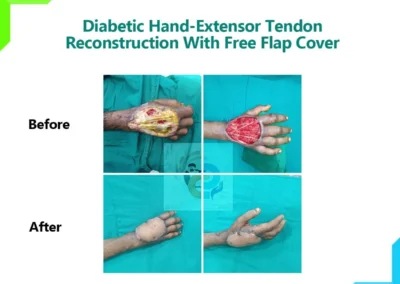 Diabetic Hand