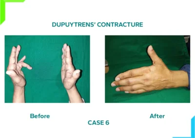 Dupuytren's Contracture