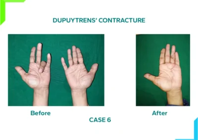 Dupuytren's Contracture