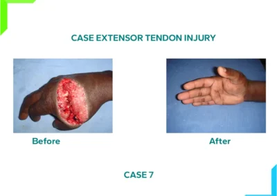 Foot extensor tendon injury