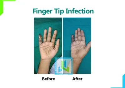Finger Tip Infection