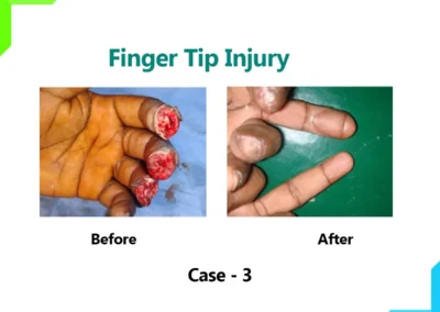 Finger Tip Injury