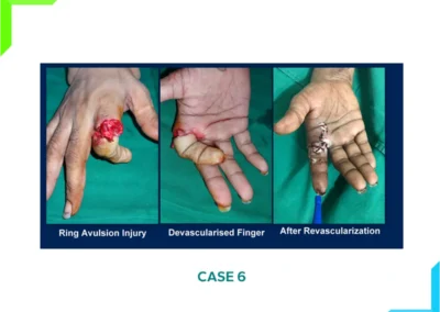 Index Finger Devascularization
