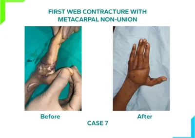 First Web Contracture