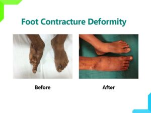 Foot Deformity