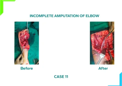 Incomplete Amputation of Elbow - Vascular repair