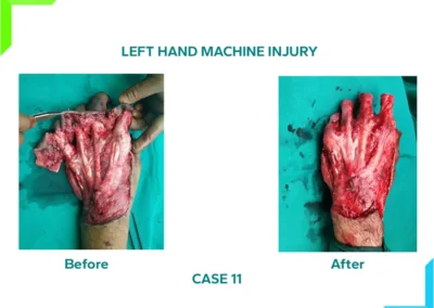 Crush begloving injury