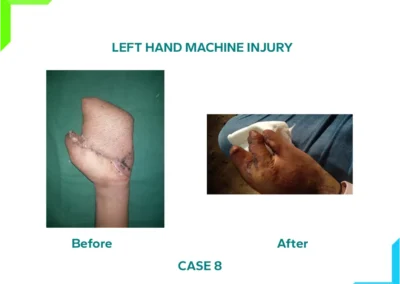 Crush begloving injury