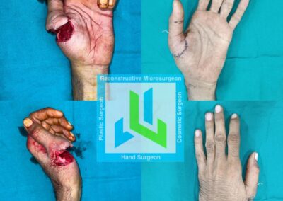 Left Thumb near total amputation