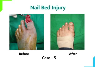 Nail Bed Injury |Dr Leena Jain