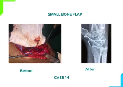 Small Bone Flap