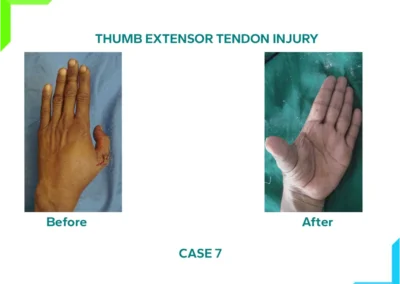 Thumb Extensor Tendon Injury