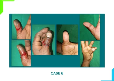 Thumb Amputation