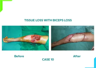Elbow crush injury with biceps loss