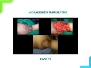 Hidradenitis Suppurativa