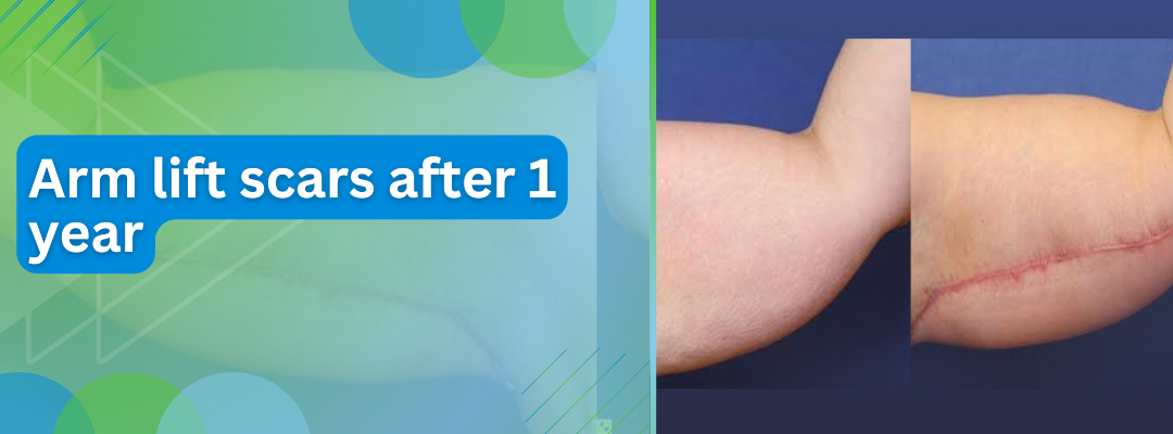 Arm Lift After 1 Year