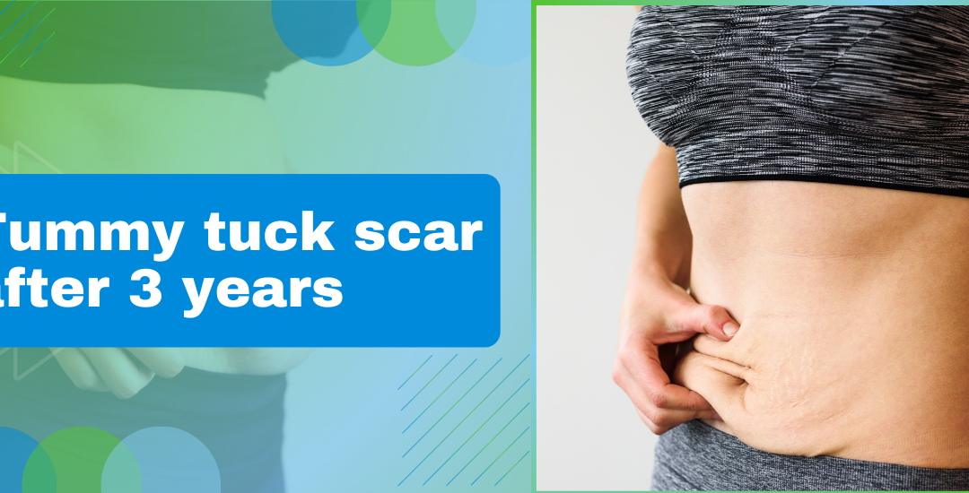 Tummy Tuck Scar After 3 Years