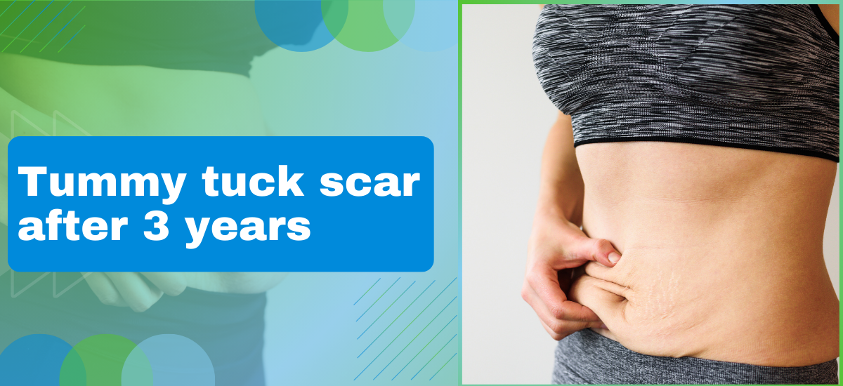 Tummy Tuck Scar After 3 Years