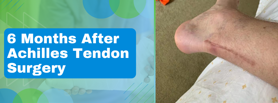 6 Months After Achilles Tendon Surgery