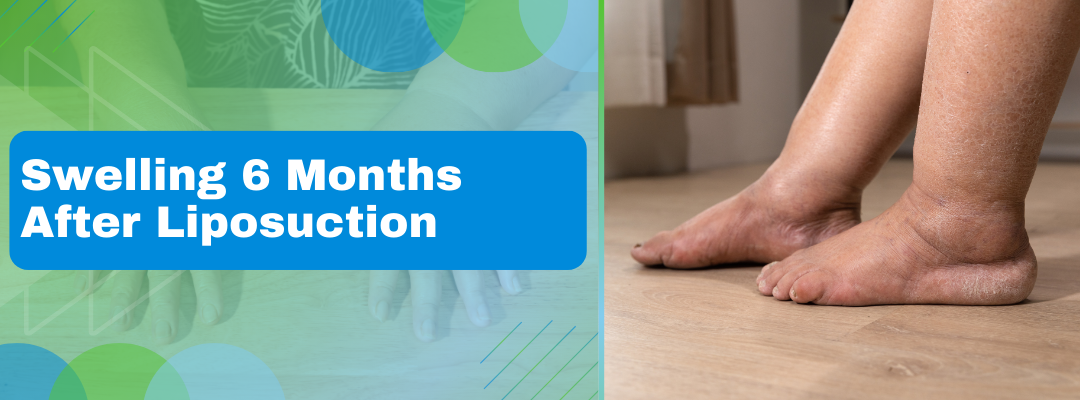 Swelling 6 Months After Liposuction