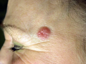 Basal cell carcinoma | Dr. Leena Jain