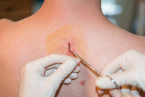 Surgery options for untreated basal carcinoma | Dr. Leena Jain