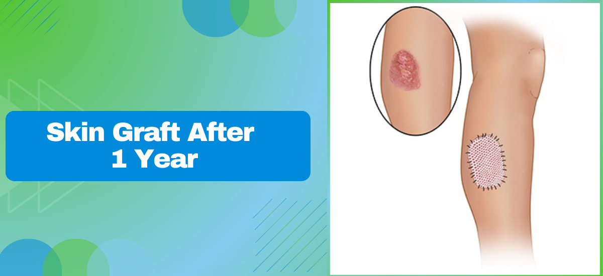 Skin Graft After 1 Year
